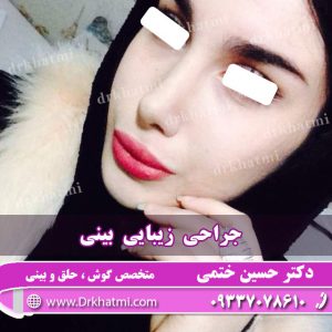 نمونه کار جراحی زیبایی بینی توسط دکتر حسین ختمی