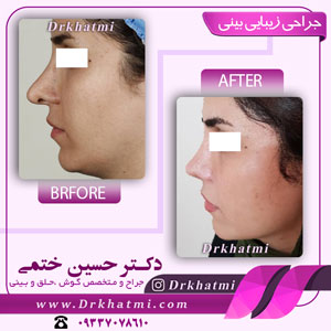 نمونه کار جراحی زیبایی بینی توسط دکتر حسین ختمی